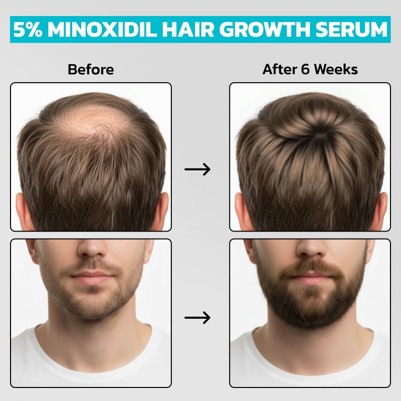 Minoxidil 5% (60ml)